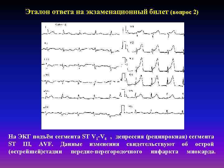 Эталон ответа на экзаменационный билет (вопрос 2) На ЭКГ подъём сегмента ST V 1