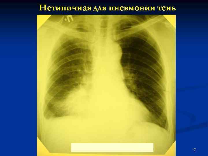 Сегментарное строение легких. Боковые проекции. 