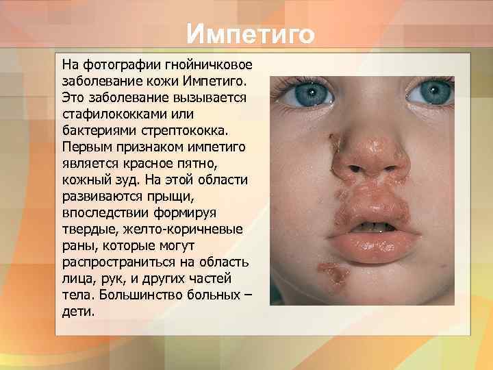 Импетиго На фотографии гнойничковое заболевание кожи Импетиго. Это заболевание вызывается стафилококками или бактериями стрептококка.