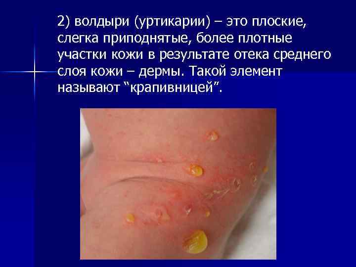 2) волдыри (уртикарии) – это плоские, слегка приподнятые, более плотные участки кожи в результате