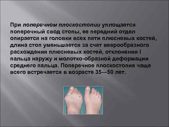 При поперечном плоскостопии уплощается поперечный свод стопы, ее передний отдел опирается на головки всех