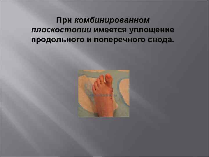 При комбинированном плоскостопии имеется уплощение продольного и поперечного свода. 