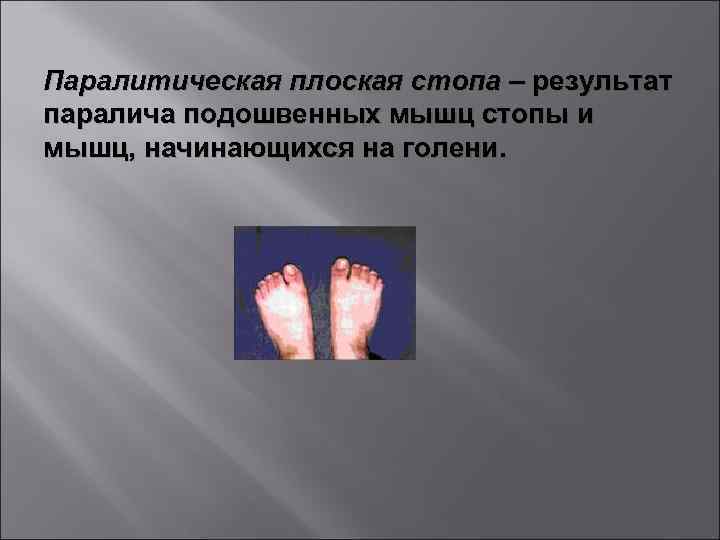 Паралитическая плоская стопа – результат паралича подошвенных мышц стопы и мышц, начинающихся на голени.