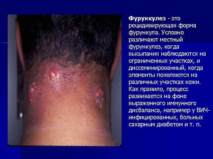 Фурункулез - это рецидивирующая форма фурункула. Условно различают местный фурункулез, когда высыпания наблюдаются на
