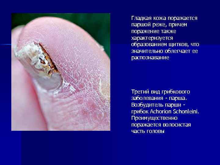 Гладкая кожа поражается паршой реже, причем поражение также характеризуется образованием щитков, что значительно облегчает