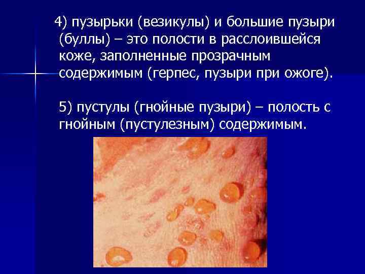 4) пузырьки (везикулы) и большие пузыри (буллы) – это полости в расслоившейся коже, заполненные