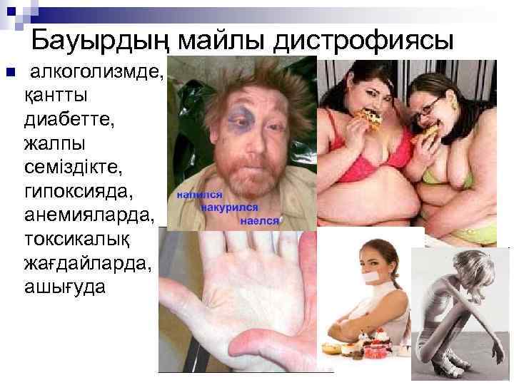 Бауырдың майлы дистрофиясы n алкоголизмде, қантты диабетте, жалпы семіздікте, гипоксияда, анемияларда, токсикалық жағдайларда, ашығуда