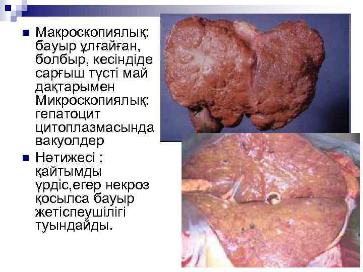 n n Макроскопиялық: бауыр ұлғайған, болбыр, кесіндіде сарғыш түсті май дақтарымен Микроскопиялық: гепатоцит цитоплазмасында