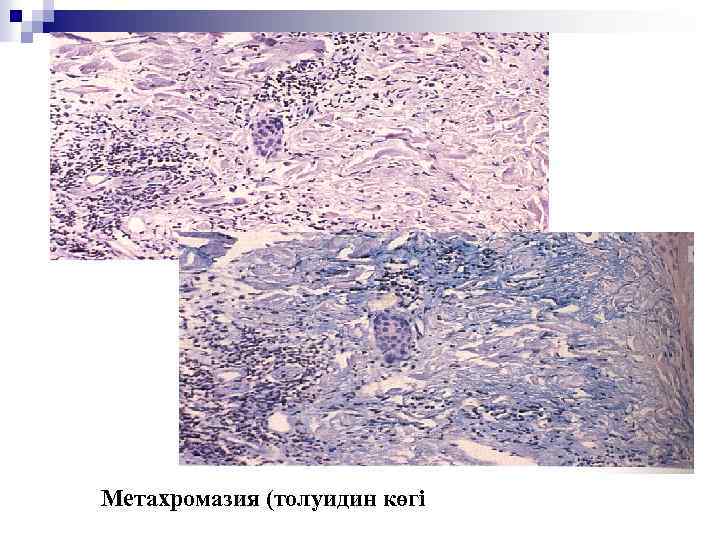 Метахромазия (толуидин көгі 