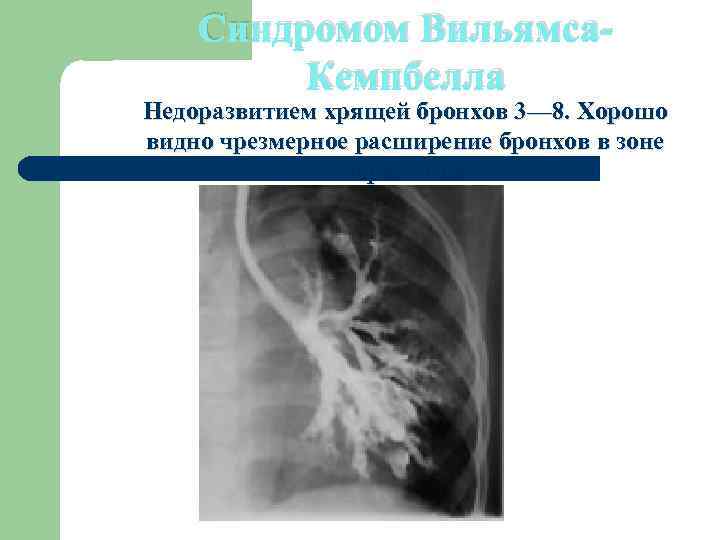 Синдромом Вильямса. Кемпбелла Недоразвитием хрящей бронхов 3— 8. Хорошо видно чрезмерное расширение бронхов в