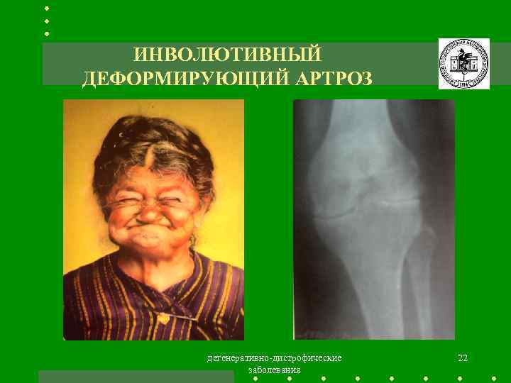 ИНВОЛЮТИВНЫЙ ДЕФОРМИРУЮЩИЙ АРТРОЗ дегенеративно-дистрофические заболевания 22 
