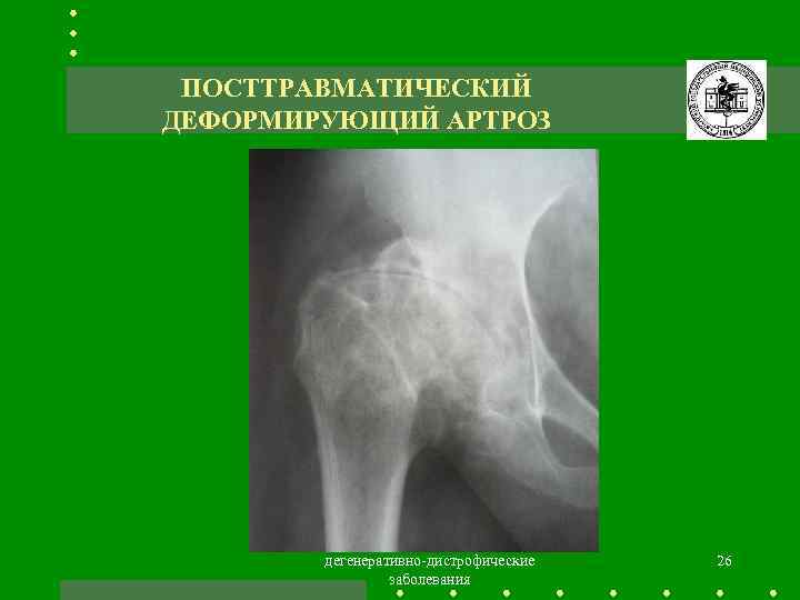 Артроз это простыми словами. Деформирующий артроз тазобедренного сустава рентген. Деформирующий остеоартроз тазобедренного сустава по Kellgren. Посттравматический артроз тазобедренного сустава рентген. Посттравматического остеоартрита..