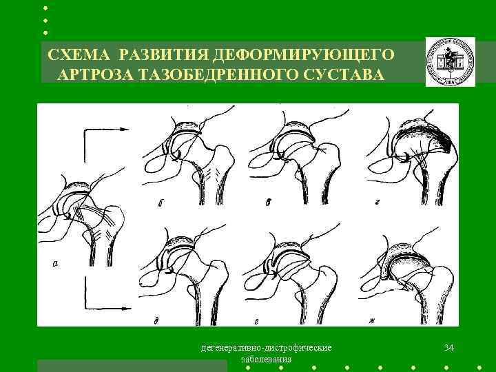 Схема лечения артроза тазобедренного сустава 2 степени