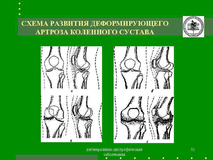 Артроз коленного сустава карта вызова