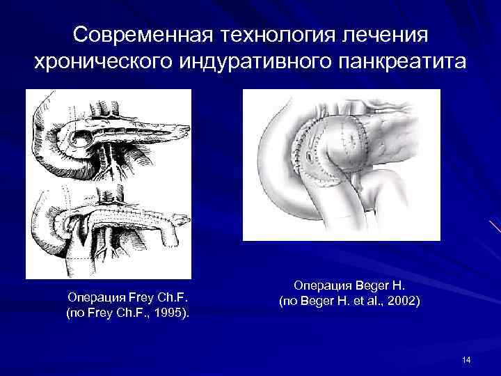 Современная технология лечения хронического индуративного панкреатита Операция Frey Ch. F. (по Frey Ch. F.