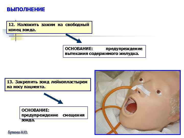 ВЫПОЛНЕНИЕ 12. Наложить зажим на свободный конец зонда. ОСНОВАНИЕ: предупреждение вытекания содержимого желудка. 13.