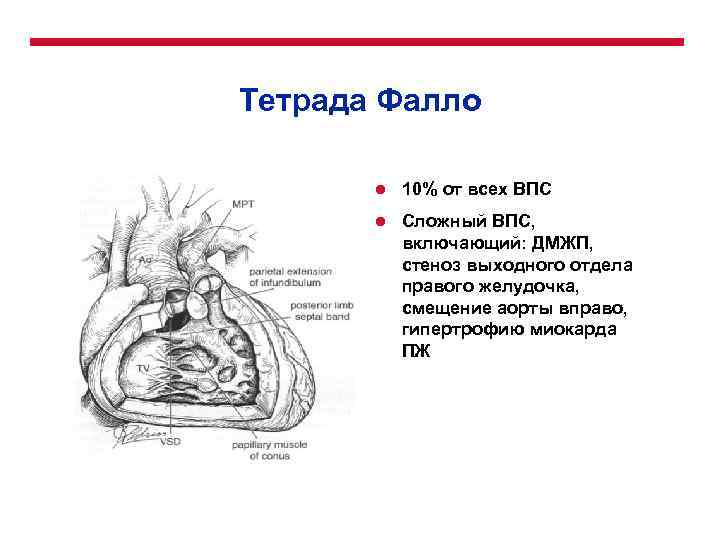 Тетрада Фалло l 10% от всех ВПС l Сложный ВПС, включающий: ДМЖП, стеноз выходного