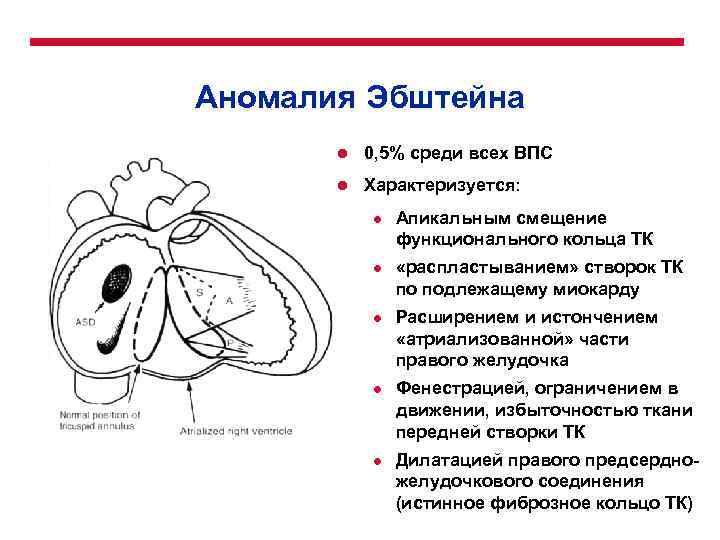 При аномалии эбштейна легочный рисунок