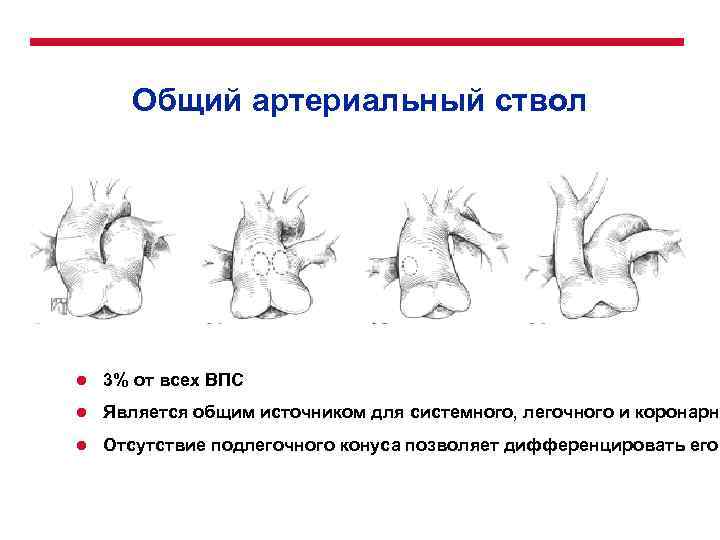 Общий артериальный ствол l 3% от всех ВПС l Является общим источником для системного,