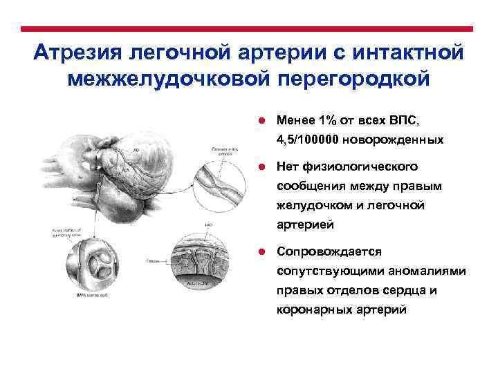 Атрезия легочной артерии с интактной межжелудочковой перегородкой l Менее 1% от всех ВПС, 4,