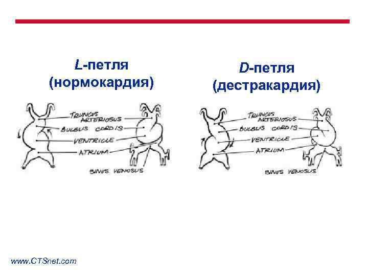 L-петля (нормокардия) www. CTSnet. com D-петля (дестракардия) 