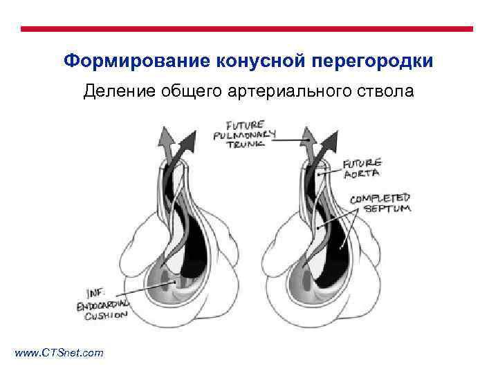 Формирование конусной перегородки Деление общего артериального ствола www. CTSnet. com 