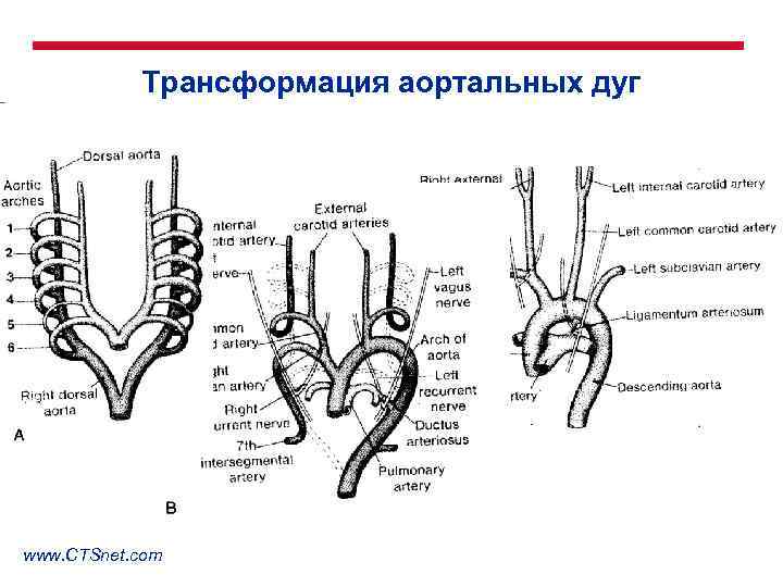 Трансформация аортальных дуг www. CTSnet. com 