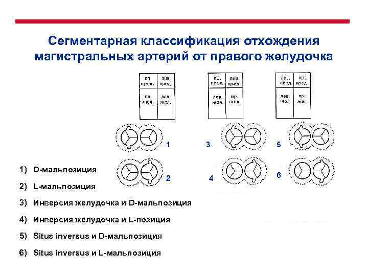 Сегментарная классификация отхождения магистральных артерий от правого желудочка 1 3 1) D-мальпозиция 2) L-мальпозиция