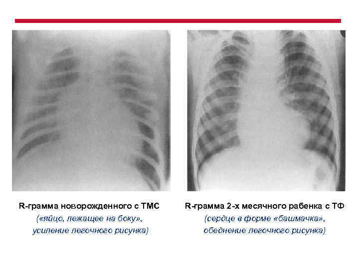 Обеднение легочного рисунка