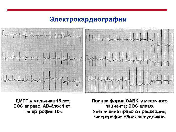 Электрокардиография ДМПП у мальчика 15 лет; ЭОС вправо, АВ-блок 1 ст. , гипертрофия ПЖ