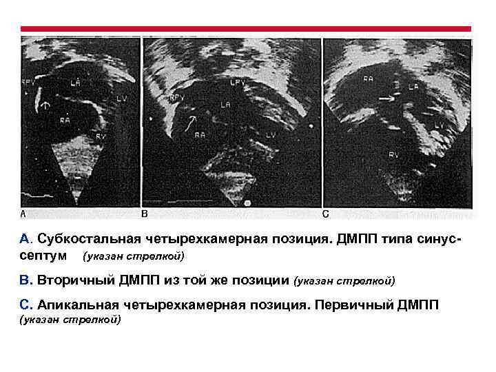 А. Субкостальная четырехкамерная позиция. ДМПП типа синуссептум (указан стрелкой) В. Вторичный ДМПП из той