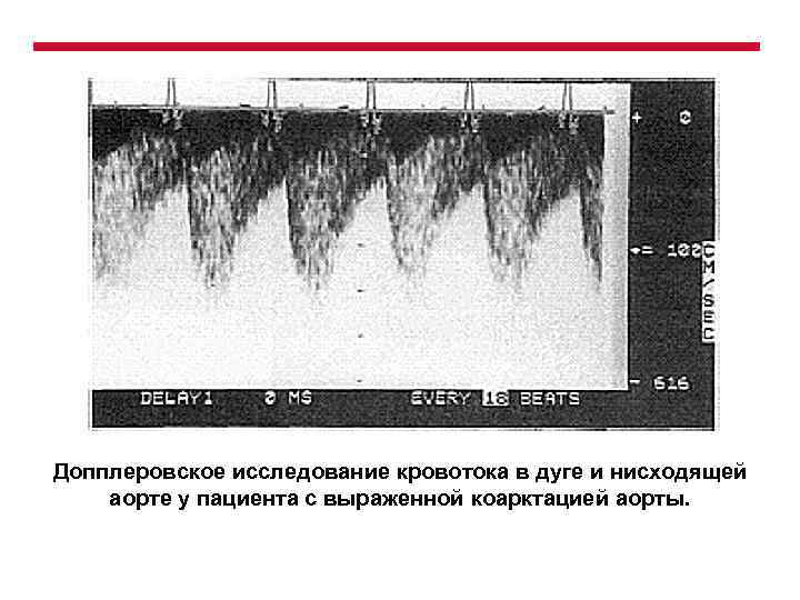 Допплеровское исследование кровотока в дуге и нисходящей аорте у пациента с выраженной коарктацией аорты.