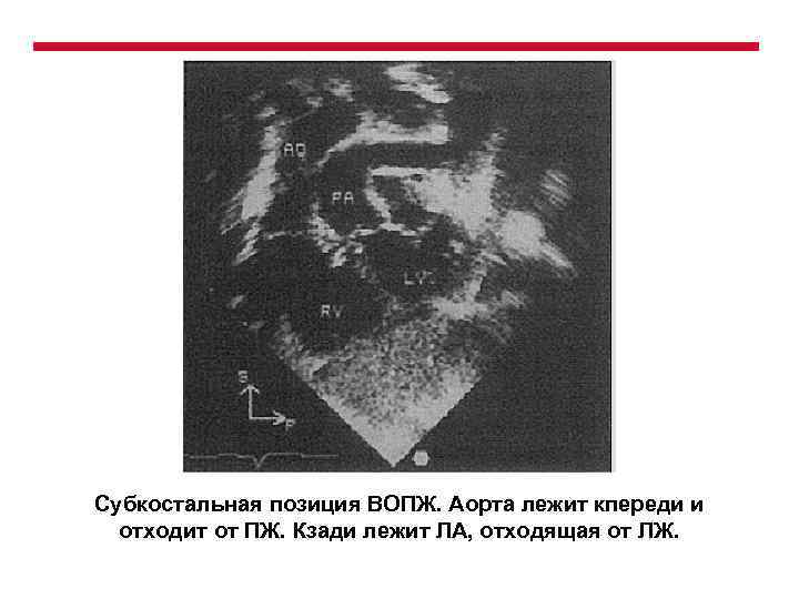 Субкостальная позиция ВОПЖ. Аорта лежит кпереди и отходит от ПЖ. Кзади лежит ЛА, отходящая
