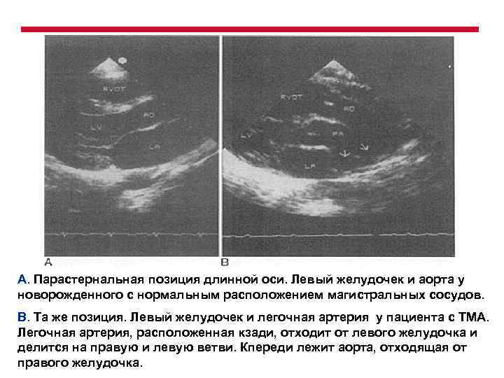 А. Парастернальная позиция длинной оси. Левый желудочек и аорта у новорожденного с нормальным расположением