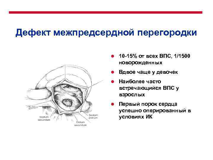 Дефект межпредсердной перегородки l 10 -15% от всех ВПС, 1/1500 новорожденных l Вдвое чаще