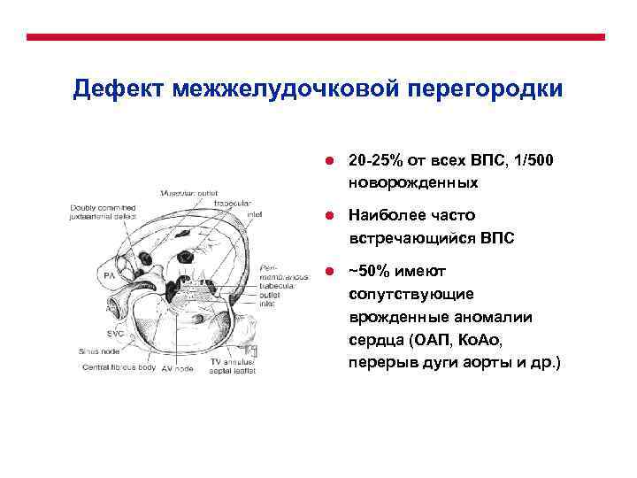 Дефект межжелудочковой перегородки l 20 -25% от всех ВПС, 1/500 новорожденных l Наиболее часто