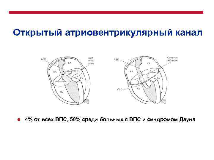 Открытый атриовентрикулярный канал l 4% от всех ВПС, 50% среди больных с ВПС и