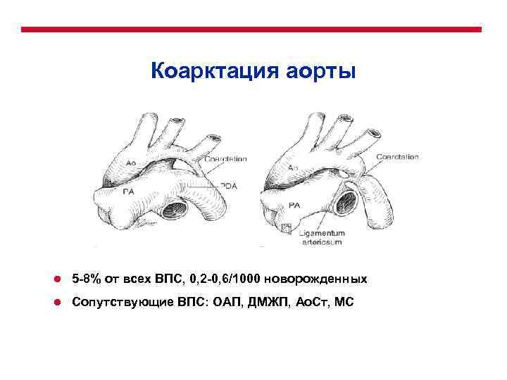 Коарктация аорты l 5 -8% от всех ВПС, 0, 2 -0, 6/1000 новорожденных l