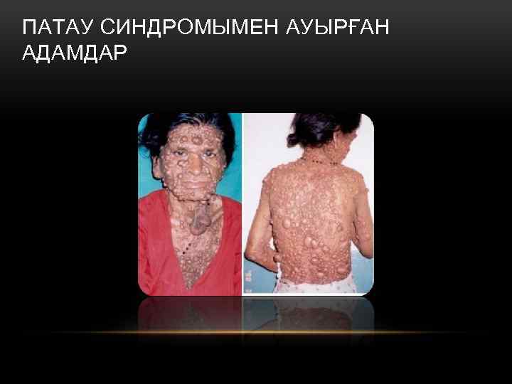 ПАТАУ СИНДРОМЫМЕН АУЫРҒАН АДАМДАР 