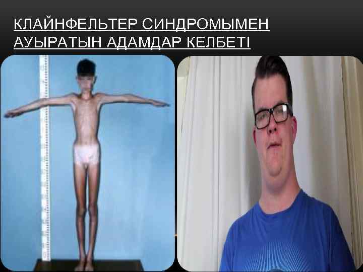 КЛАЙНФЕЛЬТЕР СИНДРОМЫМЕН АУЫРАТЫН АДАМДАР КЕЛБЕТІ 
