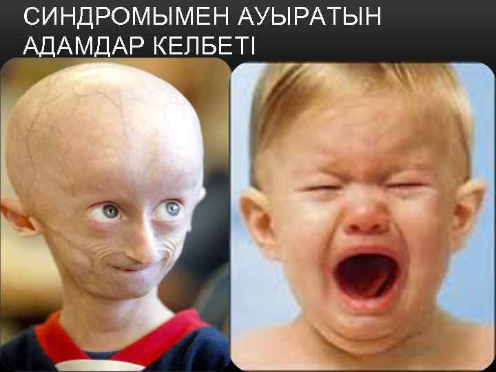 СИНДРОМЫМЕН АУЫРАТЫН АДАМДАР КЕЛБЕТІ 