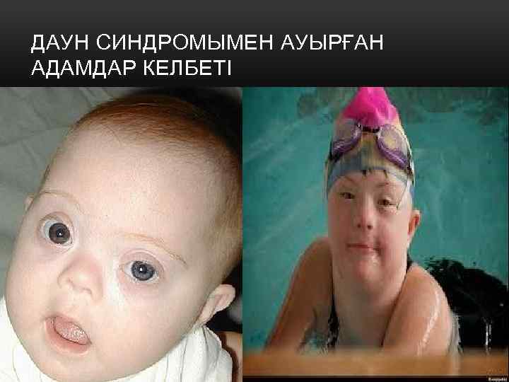 ДАУН СИНДРОМЫМЕН АУЫРҒАН АДАМДАР КЕЛБЕТІ 