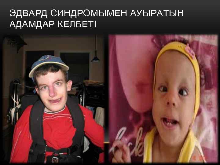 ЭДВАРД СИНДРОМЫМЕН АУЫРАТЫН АДАМДАР КЕЛБЕТІ 