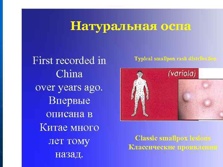 Натуральная оспа First recorded in Сhina over years ago. Впервые oписана в Китае много