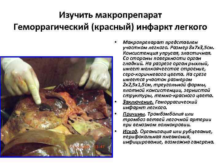  Изучить макропрепарат Геморрагический (красный) инфаркт легкого • Макропрепарат представлен участком легкого. Размер 8