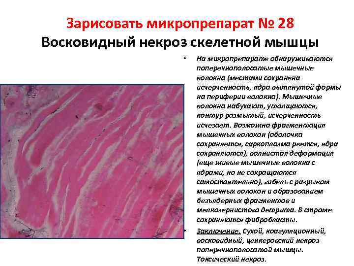  Зарисовать микропрепарат № 28 Восковидный некроз скелетной мышцы • На микропрепарате обнаруживаются поперечнополосатые
