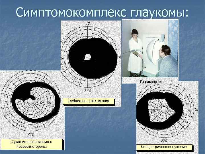 Симптомокомплекс глаукомы: 