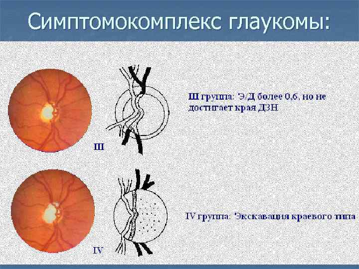 Симптомокомплекс глаукомы: 
