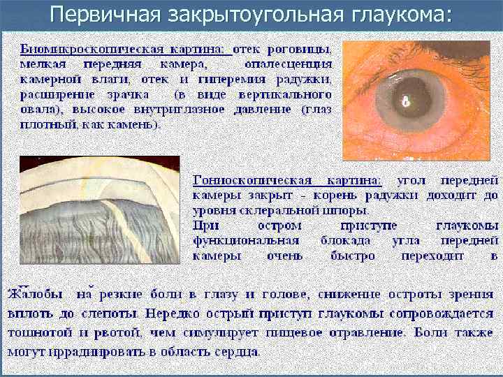 Первичная закрытоугольная глаукома: 