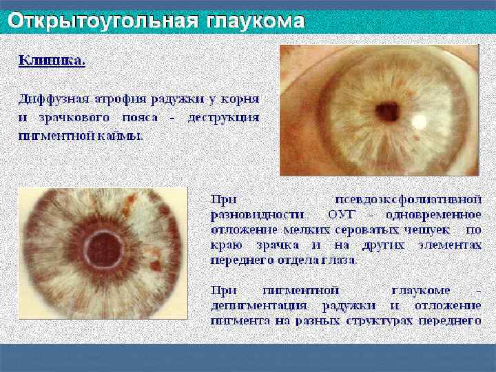 Для клинической картины лагофтальма характерно все кроме